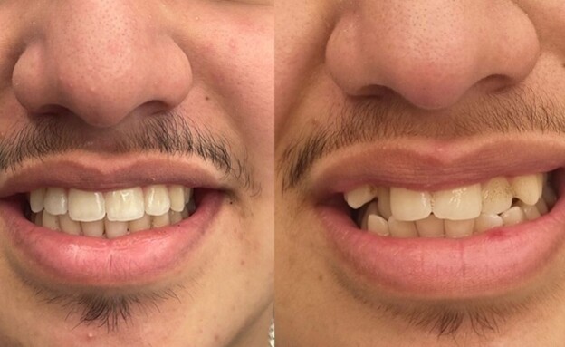 יישור שיניים באמצעות קשתיות שקופות 