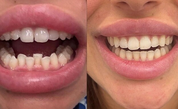 יישור שיניים באמצעות קשתיות 