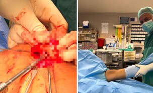 השתלת סחוס מאלמוגים (צילום: שמיר אסף הרופא)