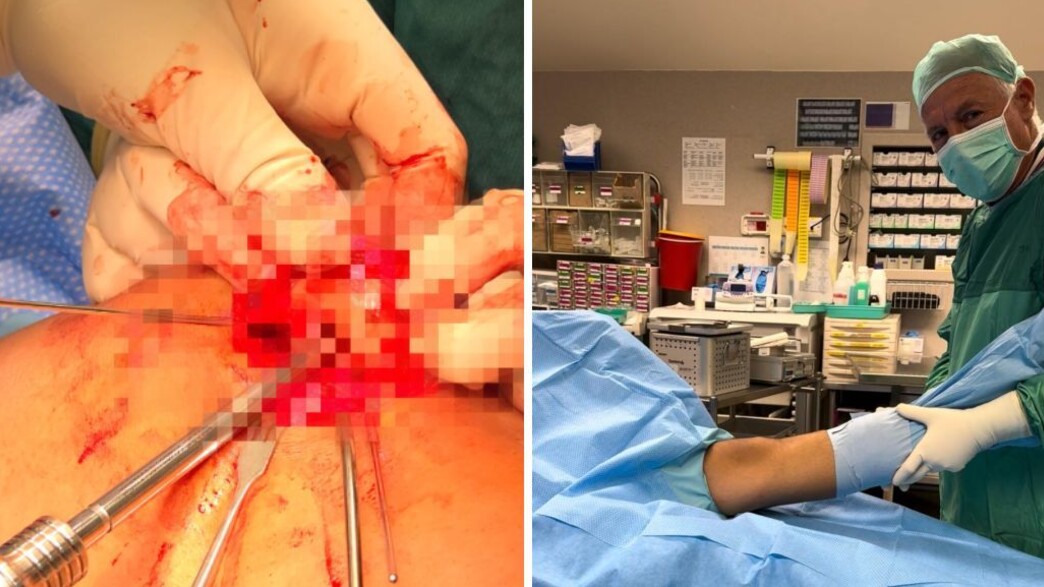 השתלת סחוס מאלמוגים