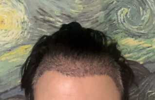 השתלות שיער, מאור