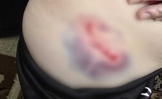 תקפו ונשכו אישה ברחוב