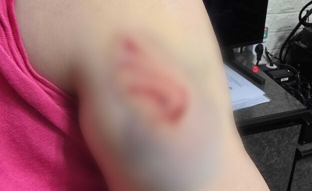 תקפו ונשכו אישה ברחוב