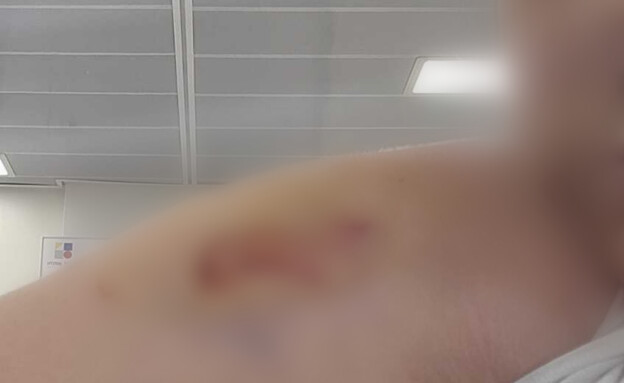 תקפו ונשכו אישה ברחוב