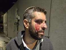 מורה בישיבה ביפו הותקף ופונה לביה"ח עם חבלות בפניו