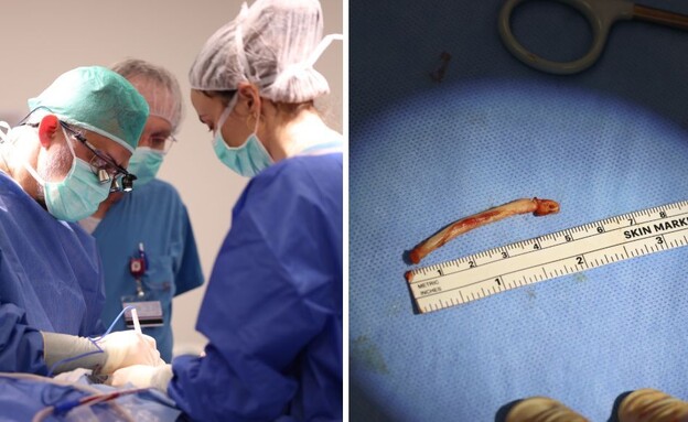 תסמונת נדירה ברמבם