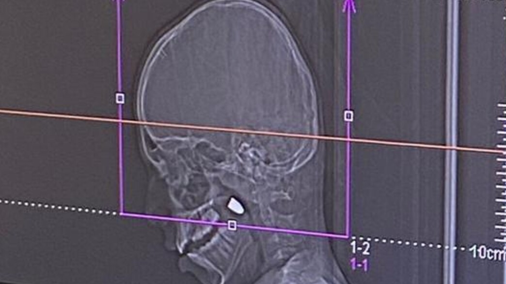 צילום הקליע בראש צילום הקליע בראש