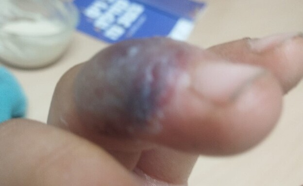 נערה הוכשה ע"י נחש שה-AI אמר לה שאינו ארסי נערה הוכשה ע"י נחש שה-AI אמר לה שאינו ארסי