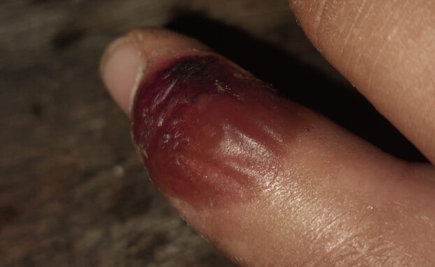 נערה הוכשה ע"י נחש שה-AI אמר לה שאינו ארסי נערה הוכשה ע"י נחש שה-AI אמר לה שאינו ארסי