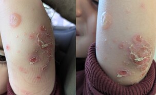 בן ה-3 נעקץ בשמורה של שפך נחל שורק (צילום: פרטי)