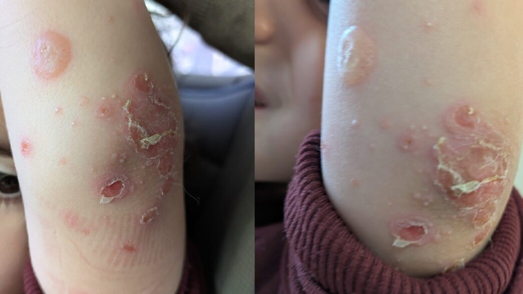 בן ה-3 נעקץ בשמורה של שפך נחל שורק בן ה-3 נעקץ בשמורה של שפך נחל שורק