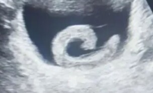 עלוקה (צילום: מתוך הרשתות החברתיות לפי סעיף 27א׳ לחוק זכויות יוצרים)