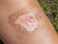 כווייה (צילום: 123rf)