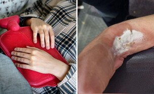 כווייה מבקבוק חם