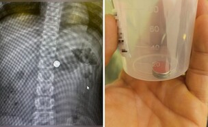 בת 10 בלעה מגנטים (צילום: קרדיט צילום למגנט - מרכז רפואי מאיר)