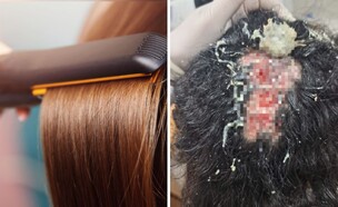 הנזק הקשה בעקבות ההחלקה (צילום: החלקת שיער - שאטרסטוק)