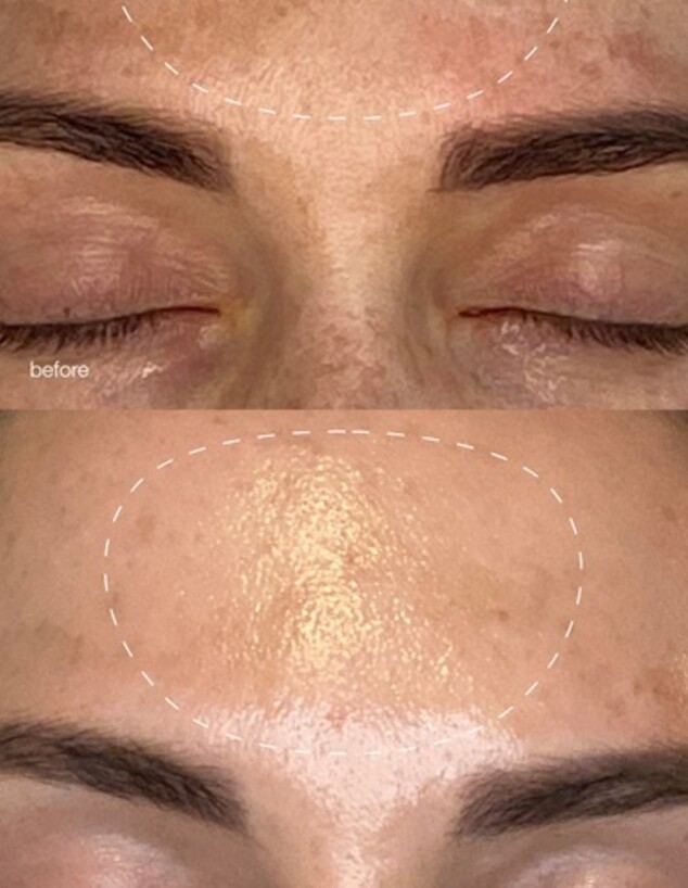 תוצאות טיפול מלאנופרו של דרמולוג'יקה 