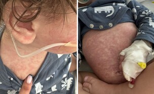 ילד עם חצבת (צילום: פרטי)