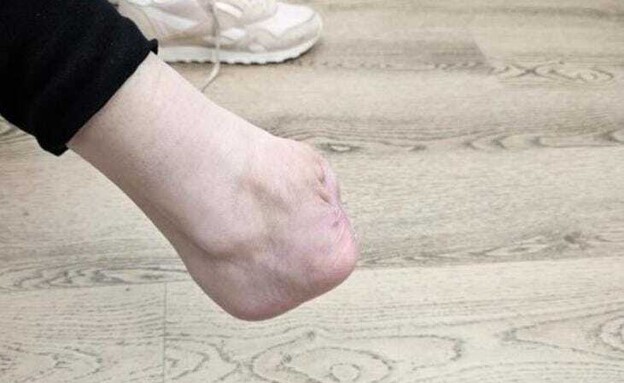 כף הרגל של נעמי (שם בדוי) לאחר הכריתה