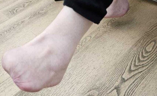 כף הרגל של נעמי (שם בדוי) לאחר הכריתה