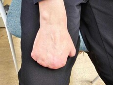 כף היד של נעמי (שם בדוי) לאחר הכריתה כף היד של נעמי (שם בדוי) לאחר הכריתה