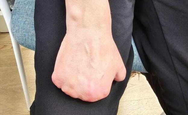 כף היד של נעמי (שם בדוי) לאחר הכריתה כף היד של נעמי (שם בדוי) לאחר הכריתה