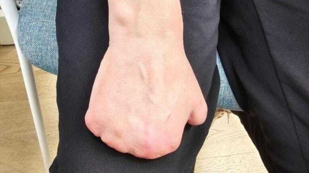 הגיעה לבית החולים בגלל מחלה בכלי הנשימה - ועברה כריתת אצבעות בידיים וברגליים