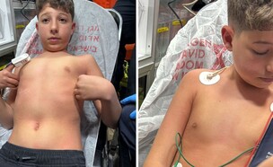 התקף האלרגיה (צילום: פרטי, שאטרסטוק)