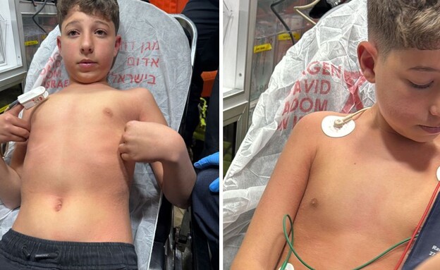 התקף האלרגיה (צילום: פרטי, שאטרסטוק)