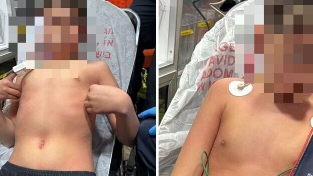 התקף האלרגיה