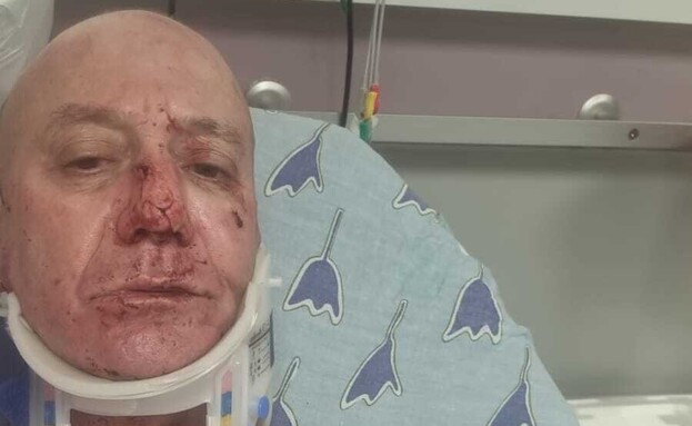 רעי צייזלר לאחר התקיפה רעי צייזלר לאחר התקיפה