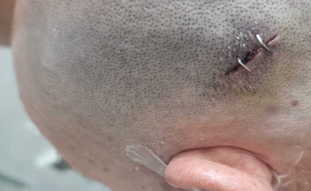 רעי צייזלר לאחר התקיפה