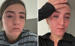 הטרק באושואיה הסתיים בנזק חמור לעיניים