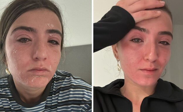 הטרק באושואיה הסתיים בנזק חמור לעיניים