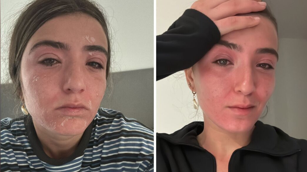 הטרק באושואיה הסתיים בנזק חמור לעיניים