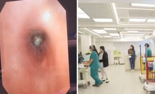 שאף בוטנים (צילום: הדסה, העמק)