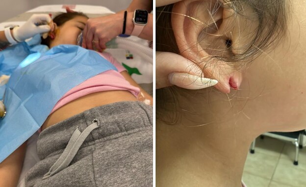 העגיל נתלש (צילום: פרטי)