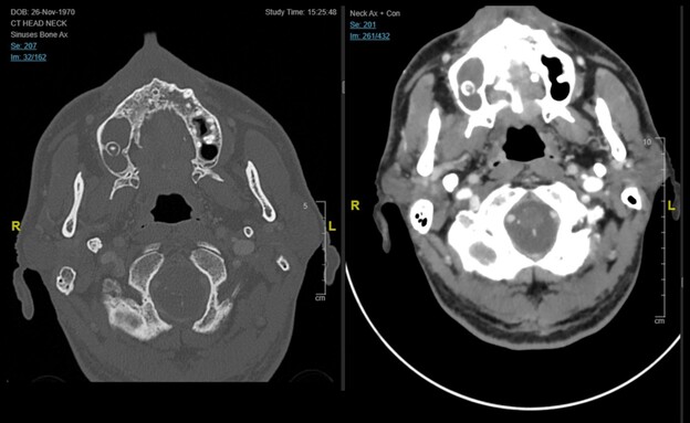 כאב בלחי שהתגלה כקטלני