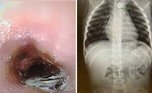 בן 3 בלע סוללת דיסק (צילום: דוברות מרכז רפואי מאיר)