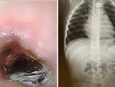 בן 3 בלע סוללת דיסק (צילום: דוברות מרכז רפואי מאיר)