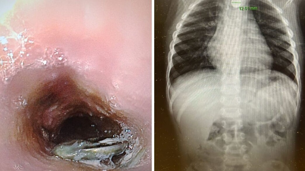 בן 3 בלע סוללת דיסק