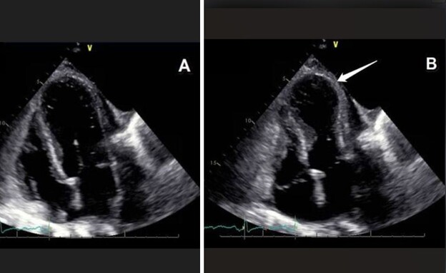 תסמונת הלב השבור