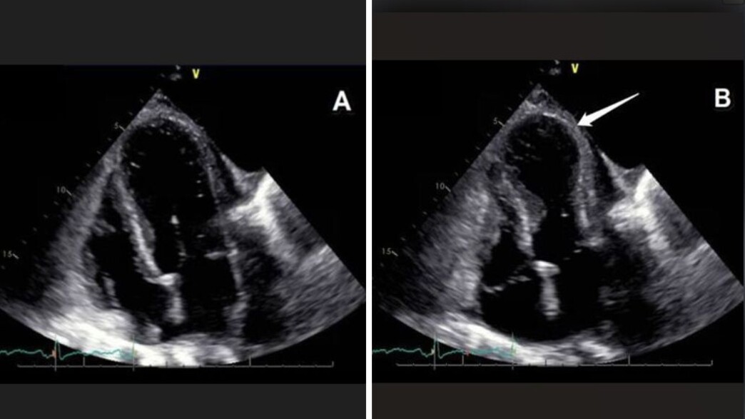 תסמונת הלב השבור
