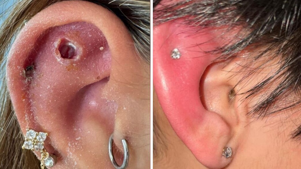 נזקי הפירסינג