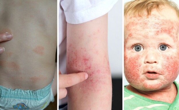 הנזקים בעור