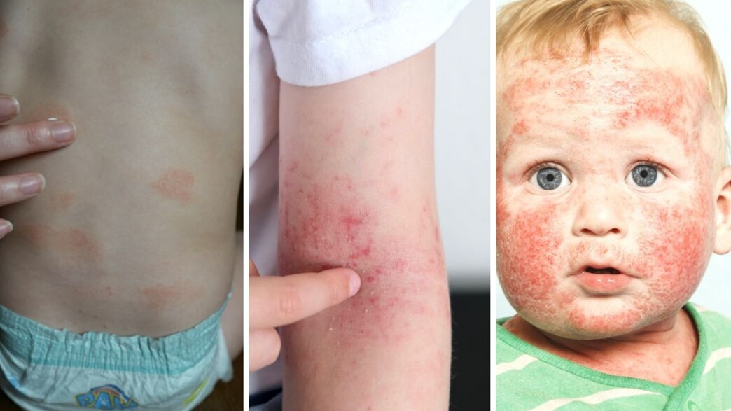 הנזקים בעור