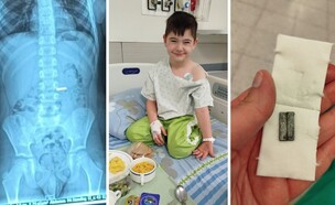 בלע מגנטים (צילום: מרכז רפואי מאיר)