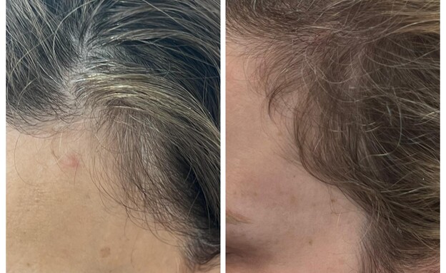 שינוי בשיער לאחר טיפול לייזר FoLix שינוי בשיער לאחר טיפול לייזר FoLix
