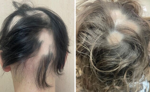 אלופציה (צילום: פרטי)