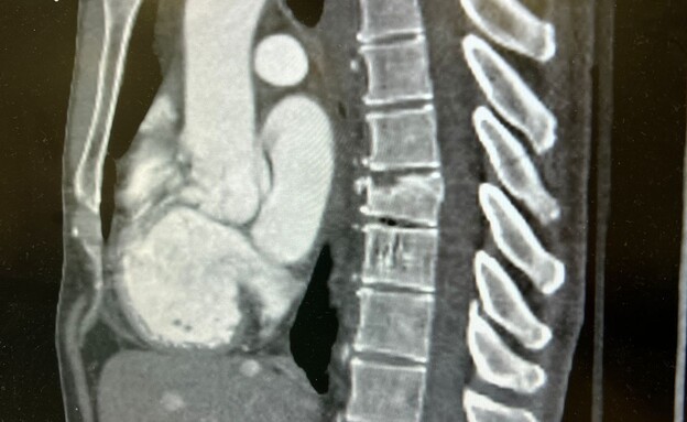 תושב גבעתיים הותקף ע"י נערים בעת שרכב על אופניים